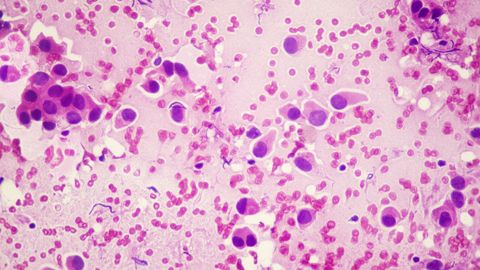 Imagen microsc&oacute;pica del c&aacute;ncer de mama.