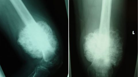 Estas imgenes son virtualmente diagnsticas de osteosarcoma