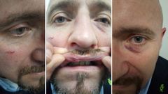 Im�genes de las heridas de Juan Manuel Rosales, coordinador de Vox en Pontevedra