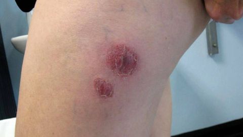 Piel infectada por la bacteria