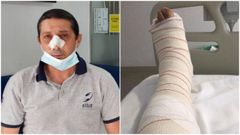 Jos� Luis G�mez, el vecino de Lugo al que le dieron una paliza a la salida de una discoteca el pasado viernes y le rompieron una pierna (imagen derecha), ya hab�a sufrido una agresi�n en el a�o 2021 (imagen izquierda).