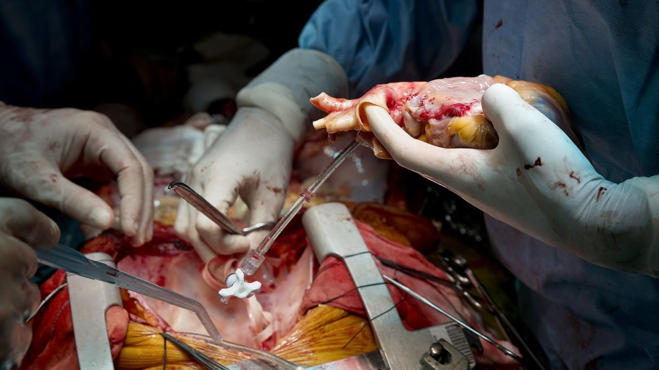 Las buenas noticias de salud del 2025: un trasplante desde dentro del quirófano y más cerca del fármaco que ralentiza el alzhéimer