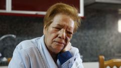 Feliciana Romero, atacada por tres pit bull en un pueblo de Muíños.