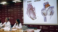 �scar, el primer caso de �xito con un coraz�n artificial total