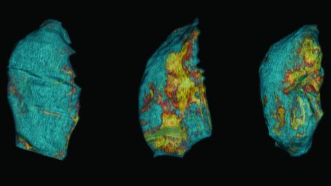 Pulmones de rat�n sanos (azules), da�ados por la ventilaci�n mec�nica (manchas amarillas) y recuper�ndose de los da�os (menos amarillo).Pulmones de rat�n sanos (azules), da�ados por la ventilaci�n mec�nica (manchas amarillas) y recuper�ndose de los da�os (menos amarillo)
