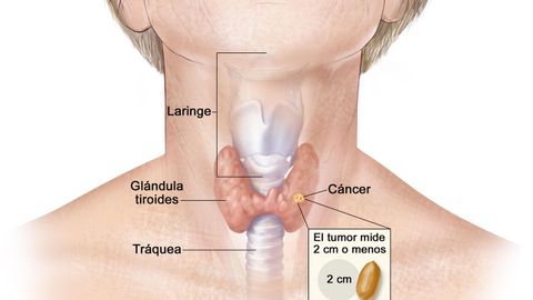 C�ncer de tiroides
