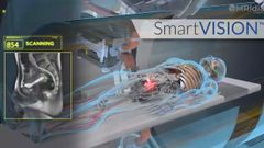 Recreaci�n de una sesi�n de radioterapia adaptativa en la que se ofrece la imagen del tumor en tiempo real.