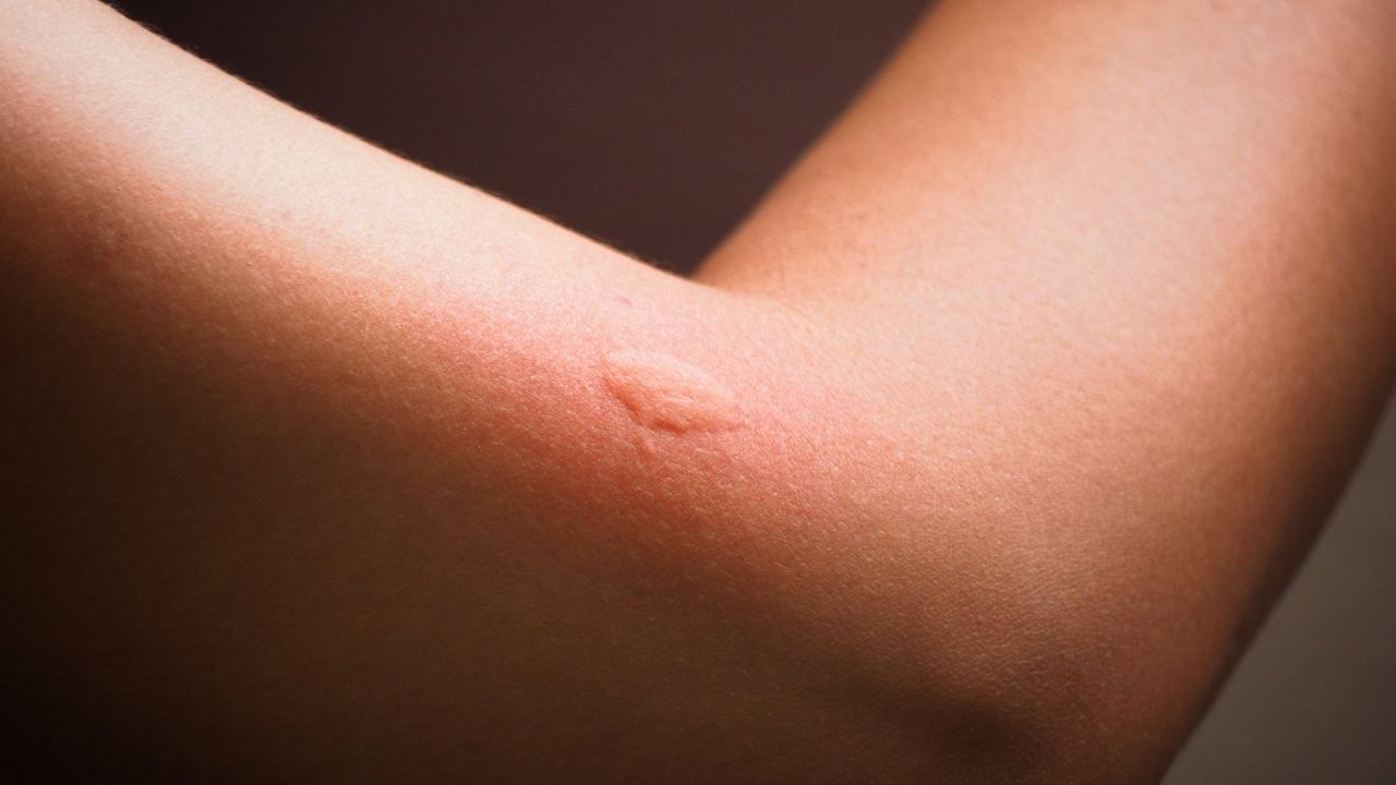Los mosquitos y Marlaska