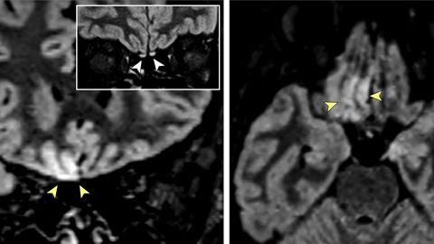 Im�genes obtenidas por resonancia magn�tica en las que los especialistas se�alan alteraciones en la zona del cerebro asociada a la percepci�n del olfato