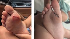 En la playa de Os Raposiños de A Pobra se produjeron varios cortes que precisaron puntos de sutura