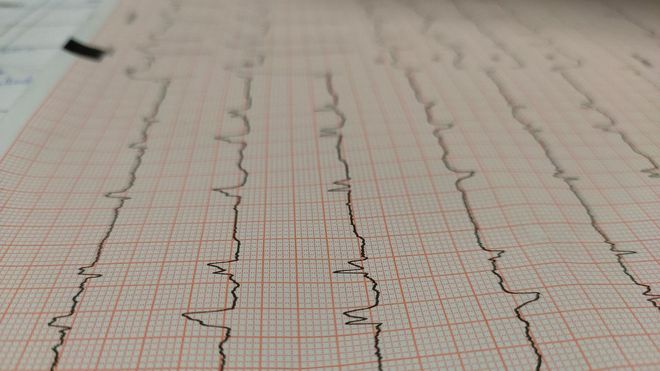 Imagen de archivo de un electrocardiograma.