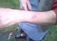 Herida causada en un brazo por una avispa velutina.